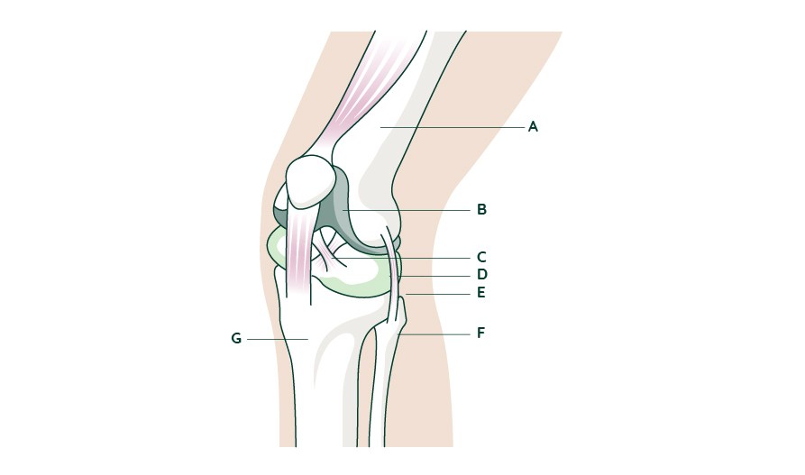 Anatomisk illustration av kn�leden med sju delar utm�rkta: l�rben, ledbrosk, korsband, menisk, ledband, vadben och skenben.